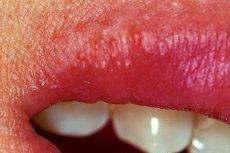 Herpes Labial Figura 20 O herpes simples é uma doença infectocontagiosa causada por vírus. Existem dois tipos de vírus do herpes simples: o tipo 1 e o tipo 2.