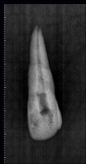 Em nenhuma das radiografias foi observada a extravasamento da lima além