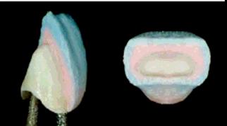 lingual/palatina e interproximal) com porcelana Opal cria uma cor