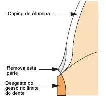 2-Método de contorno Contorne a área de margem do coping Procera com uma ponta abrasiva como por exemplo CeraMaster