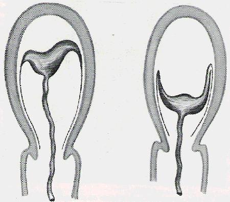 -Mecanismos de descolamento da placenta: 1.