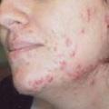 DOMINO EVO - Redução permanente de pelos - Lesões pigmentadas benignas A