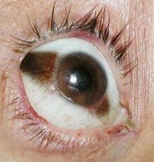 Desidratação cadavérica Consequências: Modificação dos globos oculares Sinal de Louis Sinal de