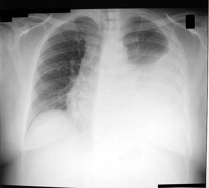 Homem de 72 anos, fumador, adenocarcinoma pulmonar com derrame pleural. Doente refere cansaço para esforços e apresenta a seguinte radiografia torácica.