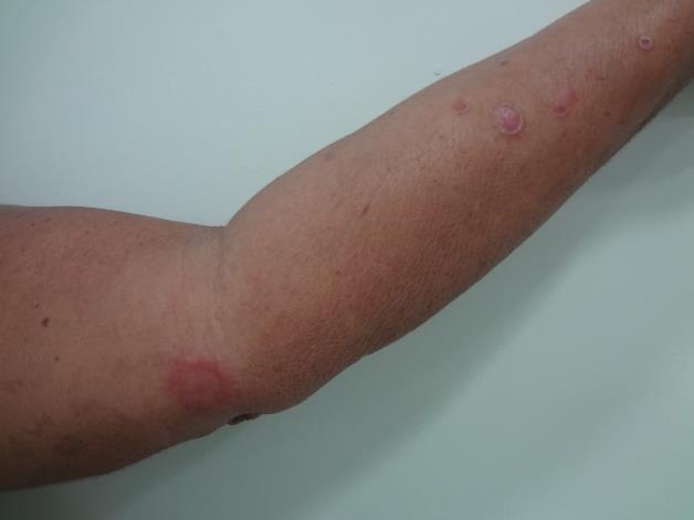 Em agosto de 2012, apresentou, ao exame dermatológico, lesões eritematoinfiltradas em braço esquerdo (Figura 3) e tornozelo esquerdo (Figura 4), com distúrbio das
