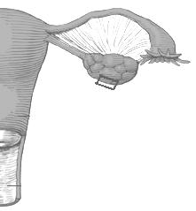 Normalmente, para a realização da laqueadura por vídeo-laparoscopia, seria necessária apenas uma abertura no abdome (um corte), geralmente feita dentro do umbigo, com um pouco mais de 1 cm de