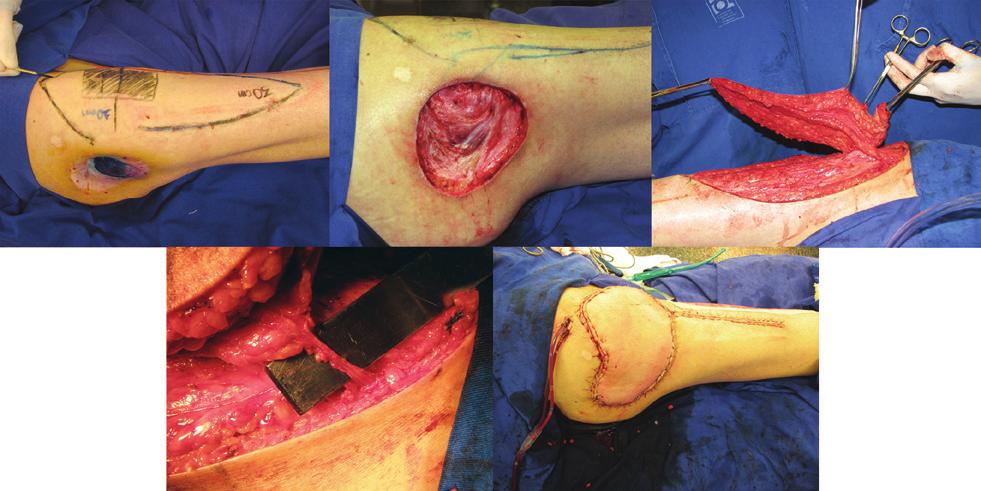 Reconstruções pelveperineais com uso de retalhos cutâneos baseados em vasos perfurantes A B C E Figura 2 Paciente com úlcera de pressão trocantérica. Em A, marcação pré-operatória.