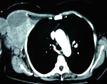 No estadiamento, foram identificadas imagens tomográficas sugestivas de metástases linfonodais na axila direita, adrenais e pulmonares (Figura 2).