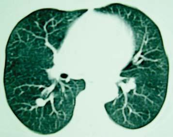 O estudo histopatológico demonstrou melanocitose dérmica com fibrose e intensa melanodermia (Figura 5).