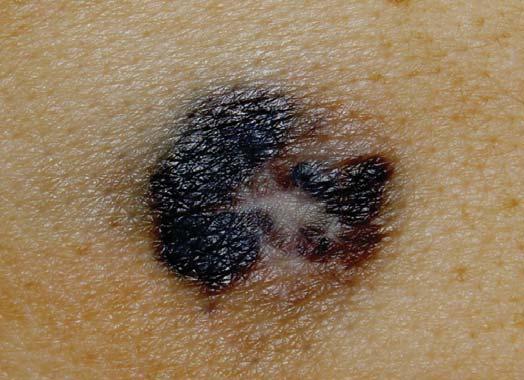 Melanoma em regressão 57 Figura 4: Mácula hipercrômica, assimétrica, entremeada por áreas deprimidas e esbranquiçadas, no dorso.