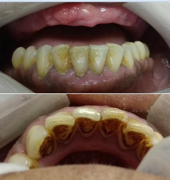 Ao exame clínico intrabucal prévio ao tratamento radioterápico, observou-se edentulismo superior, em uso de prótese total, e doença periodontal crônica nos dentes remanescentes do arco inferior