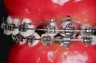 A extração de dois pré-molares superiores permite a redução efetiva da protrusão da pré-maxila, a correção da sobressaliência excessiva e possibilita o restabelecimento da harmonia muscular, além de