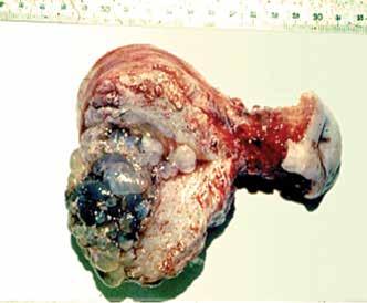 paciente por choque hemorrágico Figura 3. Mola invasora.