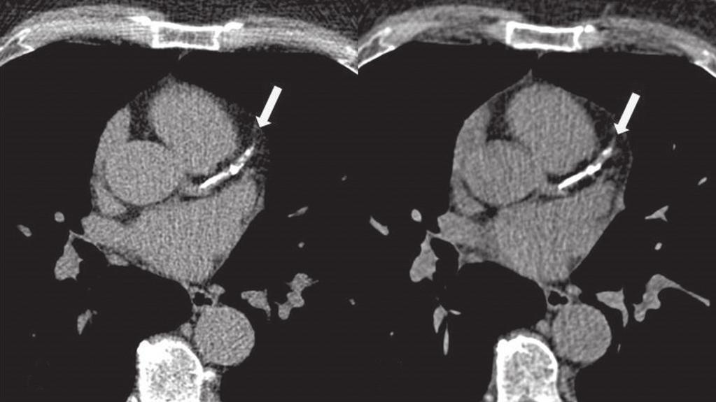 (11). Não foram realizadas medidas ou quantificações pela técnica visual, utilizada apenas para excluir ou não a presença de cálcio coronariano, conforme mostram as Figuras 1 e 2.