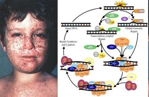 Doenças causadas por problemas no mecanismos de replicação Xeroderma pigmentosum envelhecimento