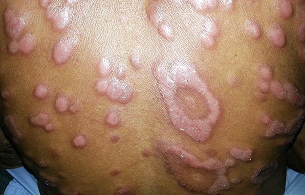 Hanseníase (Lepra) Causador: bacilo de Hansen (Mycobacterium leprae) Sintomas: lesões na pele que atingem também o sistema nervoso, fazendo com que a pessoa perca a sensibilidade na região