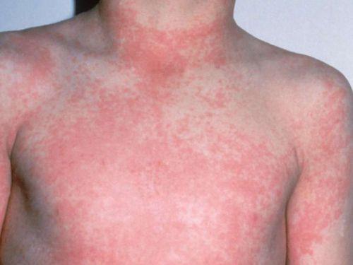 Escarlatina Causador: Streptococcus pyogenes; Sintomas: dor de garganta, febre, dores musculares, vômitos, erupções na pele e manchas