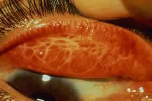 Tracoma Causador: Chlamydia trachomatis; Sintomas: inflamações na conjuntiva e na córnea, podendo levar à cegueira;