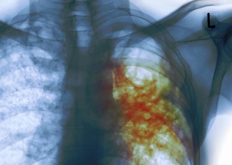 Tuberculose Causador: bacilo de Koch (Mycobacterium tuberculosis); Sintomas: ataca os pulmões, causando tosse persistente (por meses e até anos, quando não tratada), perda de peso, cansaço, febre e