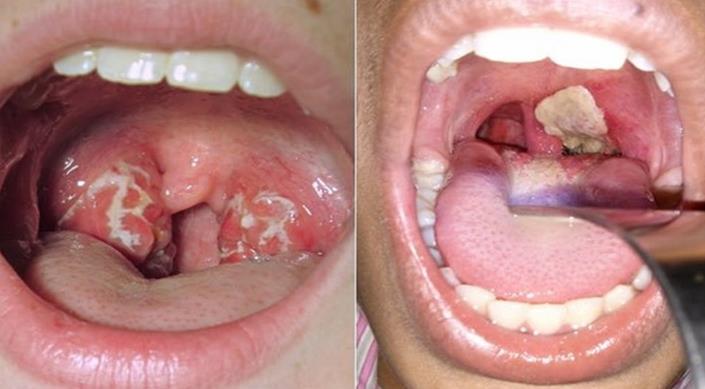 Difteria (Crupe) Causador: bacilo difetérico (Corynebacterium diphtheriae); Sintomas: colonizam principalmente a garganta e formam uma membrana branca que causa dor, febre, dificuldade para