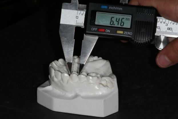 coluna, o género dos pacientes e nas seguintes as medições mésio-distais efectuadas em todos os dentes, desde o 16 até ao 26 e do 36 ao 46. FIGURA 2 Medição do dente 14 com o calibrador digital.