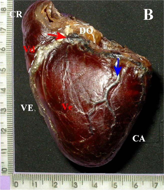 (VE); além das porções do órgão: ventrículo direito (Ve), septo interventricular