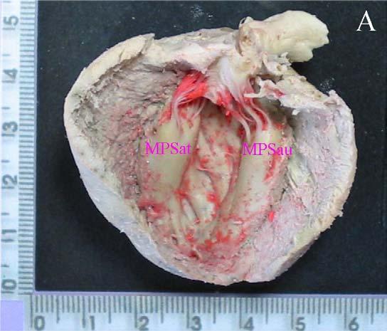 Vascularização Arterial dos Músculos Papilares do Ventrículo