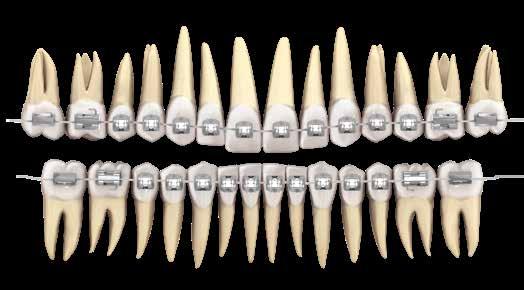 dente e slot paralelo à face incisal ou à oclusal; Pode-se usar as sobrecorreções recomendadas por McNamara para sobremordida e mordida aberta e mesmo