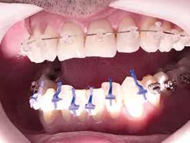 eixo da coroa. O Slot do braquetes está paralelo ao plano oclusal ou incisal.