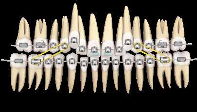 Stop na mesial dos molares para expandir o arco e evitar rotação Elástico leve noturno ¼ dos primeiros pré superiores aos primeiros molares