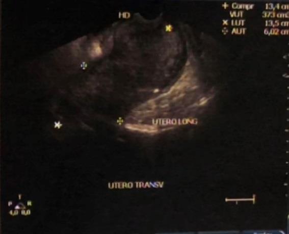 Ao toque vaginal: massa de aproximadamente 5 cm, aspecto amolecido, aparente origem uterina, ocupando a topografia do colo, sem comprometimento de paredes vaginais.