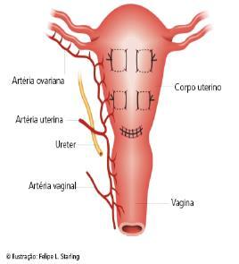 TÉCNICA SUTURA CHO Outro ponto é sucessivamente aplicado 2 a 3 cm lateralmente acima ou abaixo do primeiro, e toda parede uterina é novamente transfixada, da face posterior para