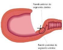 segmento uterino.
