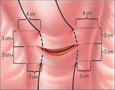 TÉCNICA SUTURA B-LYNCH Pontos de fixação da sutura: A parede anterior direita é transfixada 3 cm abaixo da borda inferior da histerotomia e a