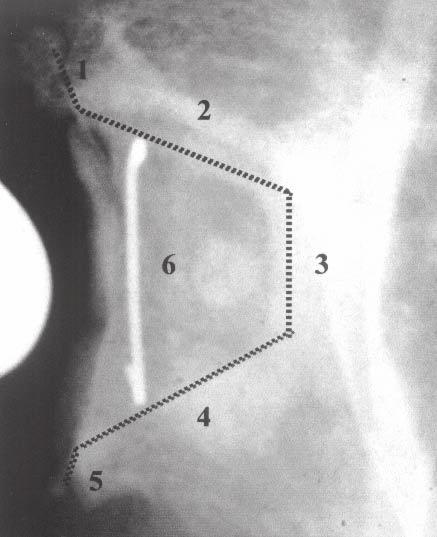 Avaliação de resultados em artroplastia total de ombro 175 Diversas foram as doenças que levaram à indicação da ATO, sendo a mais comum a osteoartrose primária, conforme a tabela 2.