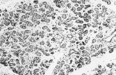 FIGURA 3 - Ácinos residuais na periferia do lóbulo, contendo grânulos de secreção PAS-positivos com 10 dias de atrofia glandular. PAS, aumento original 400X.