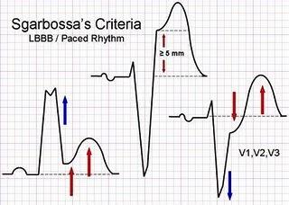 paciente com dor torácica e BRE é um desafio, já que as alterações da repolarização ventricular secundárias ao bloqueio são empecilhos na análise do segmento ST e da onda T.