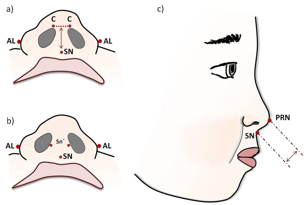 32 4 Material e Métodos no grupo controle, onde os valores das medidas pós-cirurgia serão comparados aos valores do grupo controle. Figura 2 - Pontos antropométricos.