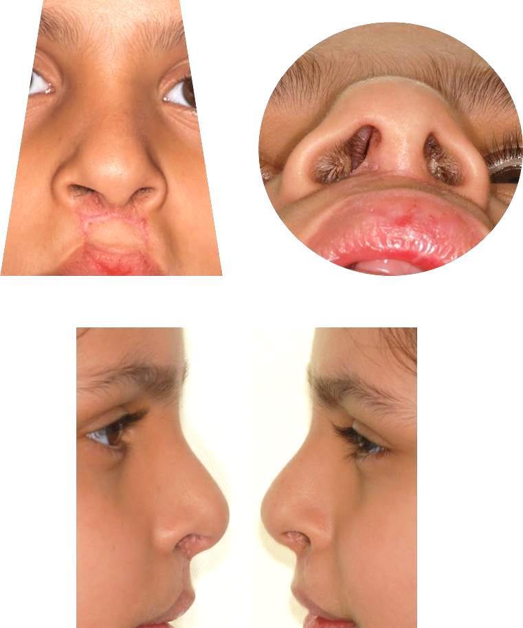 34 4 Material e Métodos Primeiro grupo: Escores 1 + 2: Muito bom + bom Figura 3 - Vista frontal: forma nasal;