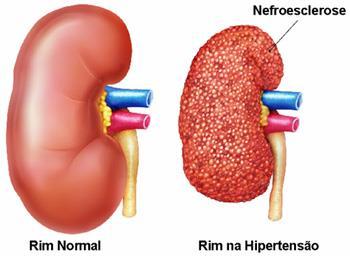 HIPERTENSÃO ARTERIAL