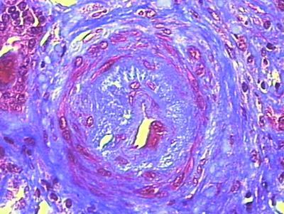 Microangiopatia trombótica Plaquetopenia Anemia microangiopática Insuficiência renal aguda Hipertensão arterial maligna Síndrome