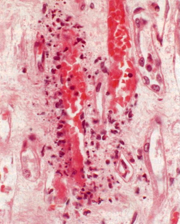 Glomerulonefrite crescêntica 50% dos glomérulos ANCA - positivo - Poliangeite microscópica (P-anca) sem asma ou granuloma - Poliangeite Granulomatosa (Wegener