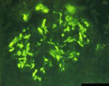 Glomerulonefrite crescêntica 50% dos glomérulos - Tipo