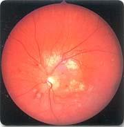 Retinopatia hipertensiva http://health.