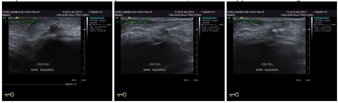 Cirurgia PO (27/07/2018) RESSECÇÃO SEGMENTAR DE MAMA E + BLS A E + MAMOPLASTIA ONCOLÓGICA ME: CI SOE GH1. Tamanho da área invasiva: 0,7cm. ILV -. Margens livres.