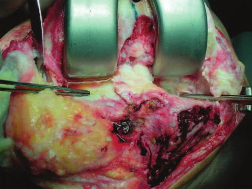 Enxertia óssea em artroplastia primária do joelho: avaliação transoperatória 401 Figura 1 Defeito central ou contido Figura 2 Defeito periférico A indicação de enxertia óssea foi para preenchimento