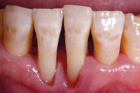 periodontal evitando interferências