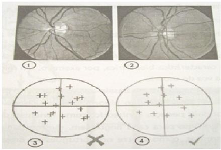 2.4.3. Retina A biometria da retina segundo Romagnoli (2002) é baseada na análise da camada dos vasos sanguíneos no fundo dos olhos.