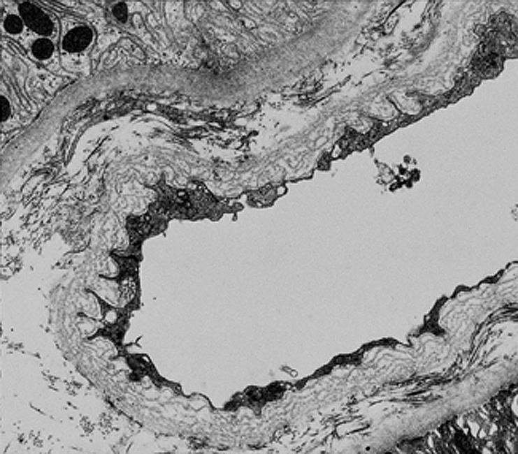 Capilar peritubular Alterações ultra-estruturais Membrana Basal capilar peritubular