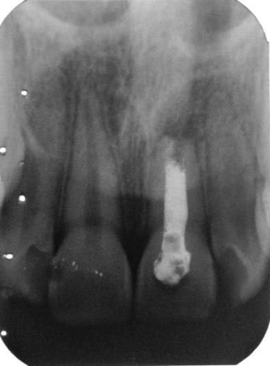 2015 Figura 12.  regressão de lesão periapical 02.